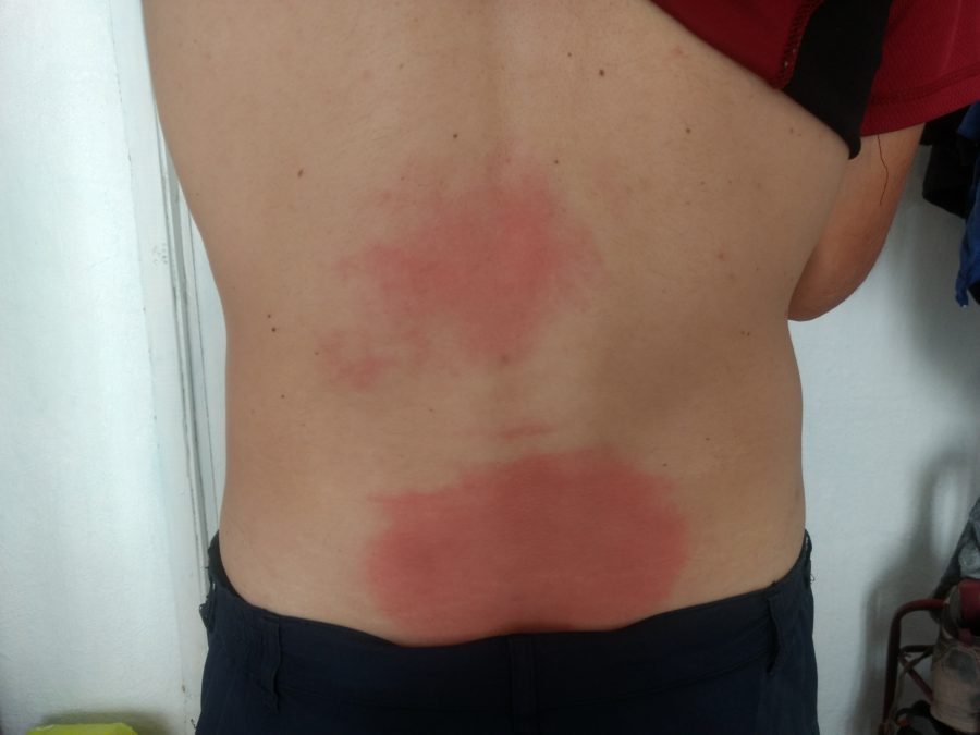 Red marks on back from overly hot mud pack electrocution treatment at the Jeti-Oguz sanatorium