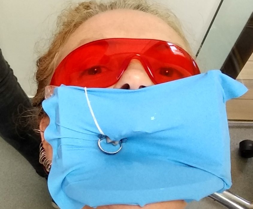 Using a dental shield to prevent further infection during a root canal - dental treatment in Bucharest