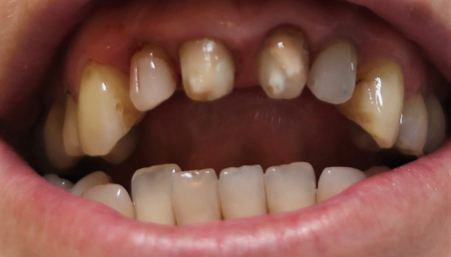 Rebuilt laterals and fillings in remaining teeth